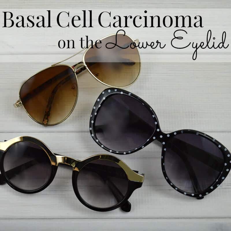 Basal Cell Carcinoma on the Lower Eyelid – Part 1